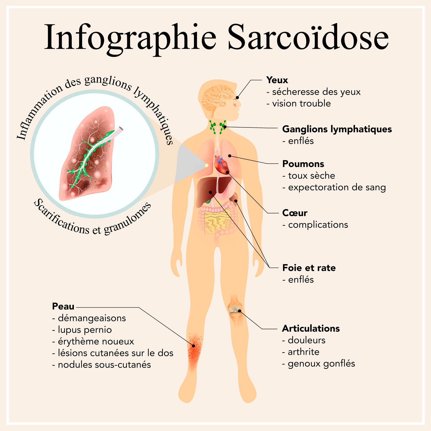 sarcoidose